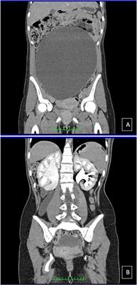 Minimally invasive management of a giant paratubal cyst in an adolescent female: Case report and review of the literature in the pediatric population